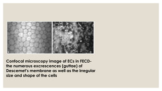 Confocal microscopy image of ECs in FECD-
the numerous excrescences (guttae) of
Descemet’s membrane as well as the irregular
size and shape of the cells
 