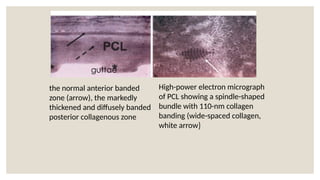 the normal anterior banded
zone (arrow), the markedly
thickened and diffusely banded
posterior collagenous zone
guttae
High-power electron micrograph
of PCL showing a spindle-shaped
bundle with 110-nm collagen
banding (wide-spaced collagen,
white arrow)
 
