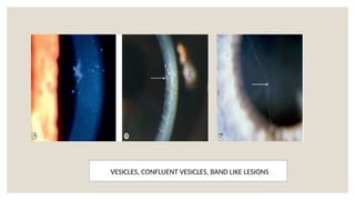 VESICLES, CONFLUENT VESICLES, BAND LIKE LESIONS
 