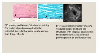 PAS staining and Masson’s trichrome staining:
The endothelium is replaced with flat
epithelial-like cells that grow focally as more
than 1 layer of cells
In vivo confocal microscopy showing
vesicular lesions and band-like
structures with irregular edges within
the endothelium associated with
polymegathism of endothelial cells
 