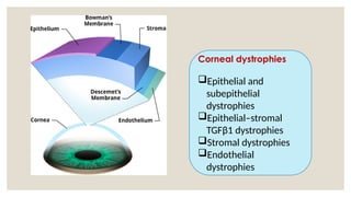 Corneal dystrophies
Epithelial and
subepithelial
dystrophies
Epithelial–stromal
TGFβ1 dystrophies
Stromal dystrophies
Endothelial
dystrophies
 