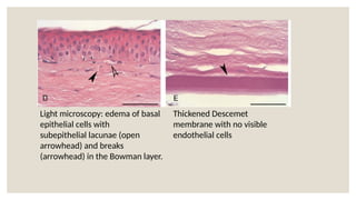 Light microscopy: edema of basal
epithelial cells with
subepithelial lacunae (open
arrowhead) and breaks
(arrowhead) in the Bowman layer.
Thickened Descemet
membrane with no visible
endothelial cells
 