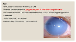 Signs
◦ Diffuse corneal edema, thickening of DM
◦ Corneal edema varies from grey ground glass to total corneal opacification
◦ On retroillumination, Descemet’s membrane may show a beaten copper appearance.
◦ Treatment
lamellar ( DSAEK,DSEK,DMEK)
or Penetrating Keratoplasty ( gold standard)
 