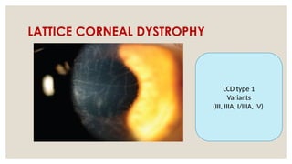 LATTICE CORNEAL DYSTROPHY
LCD type 1
Variants
(III, IIIA, I/IIIA, IV)
 