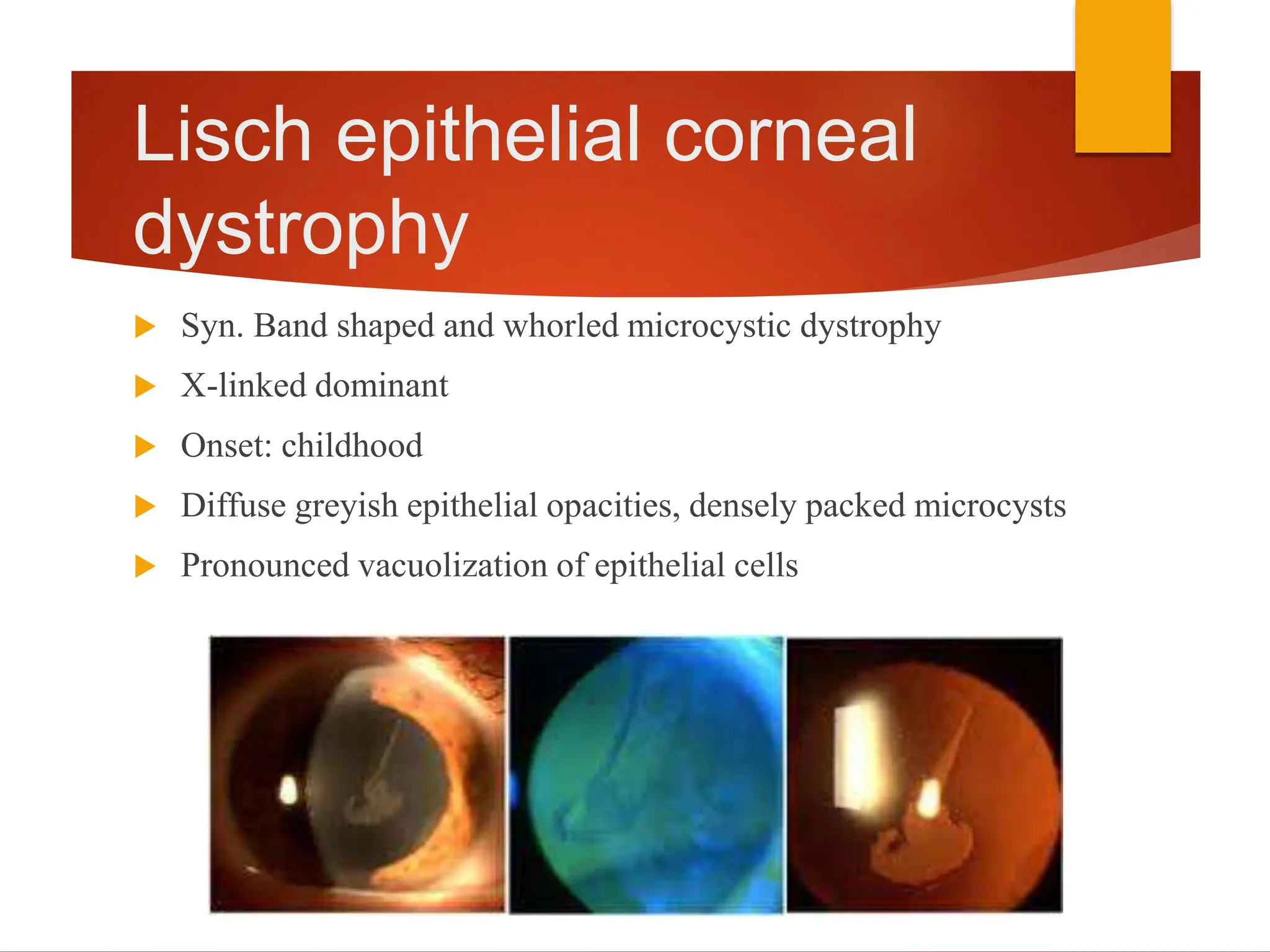 Corneal Dystrophy And Corneal Disorders 1 pptx