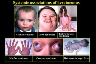 Systemic associations of keratoconus

Atopic dermatitis

Marfan syndrome

Down syndrome

Crouzon syndrome

Ehlers-Danlos
syndrome

Osteogenesis imperfecta

 