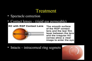 Treatment
• Spectacle correction
• Contact lenses – (rigid gas permeable)

• Intacts – intracorneal ring segmets

 