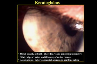 Keratoglobus

Onset usually at birth (hereditary and congenital disorder)
• Bilateral protrusion and thinning of entire cornea
• Associations - Leber congenital amaurosis and blue sclera
•

 