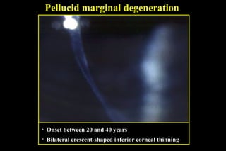 Pellucid marginal degeneration

•

Onset between 20 and 40 years

•

Bilateral crescent-shaped inferior corneal thinning

 
