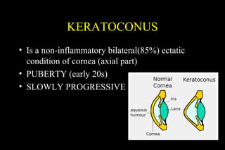KERATOCONUS
• Is a non-inflammatory bilateral(85%) ectatic
condition of cornea (axial part)
• PUBERTY (early 20s)
• SLOWLY PROGRESSIVE

 