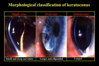 Morphological classification of keratoconus
Nipple cone

Oval cone

Small and steep curvature

Larger and ellipsoidal

Globus cone

Largest

 