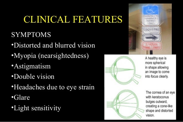 Corneal ectasias