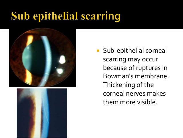 Corneal Ectasias