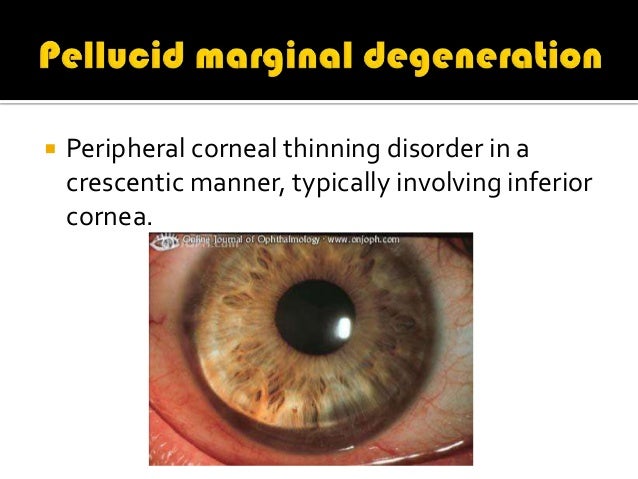 definition of pellucid definition of pellucid