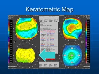 Keratometric Map