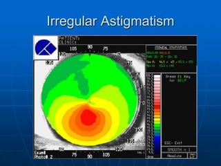 Irregular Astigmatism