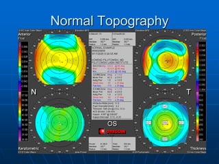 Normal Topography