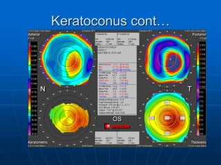 Keratoconus cont…