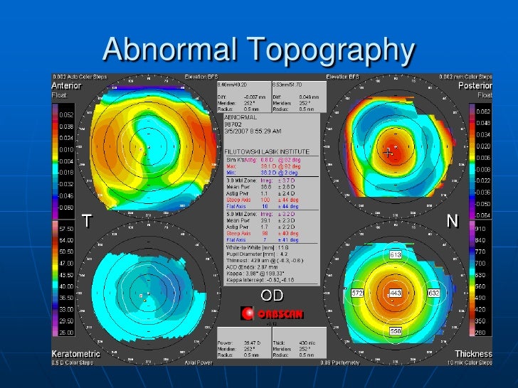 Cornea Topography