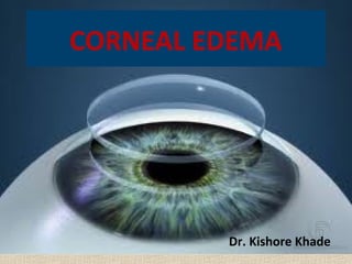CORNEAL EDEMA




         Dr. Kishore Khade
 