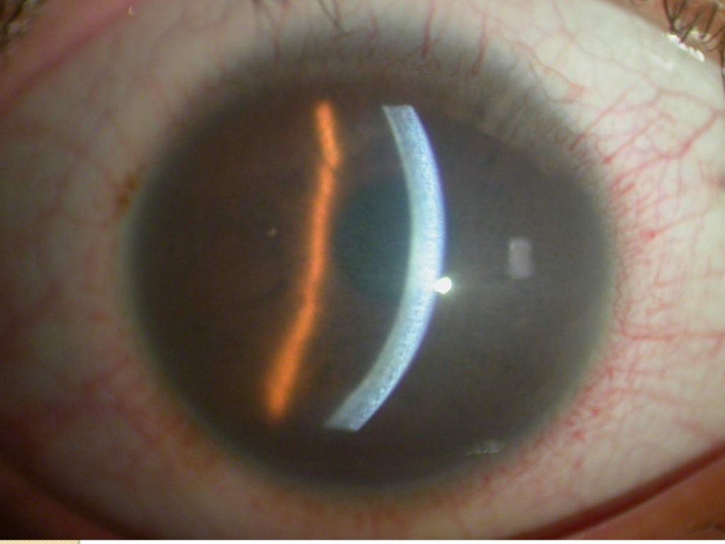 Corneal edema