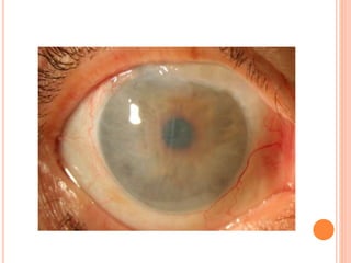 Corneal Edema After Cataract Surgery