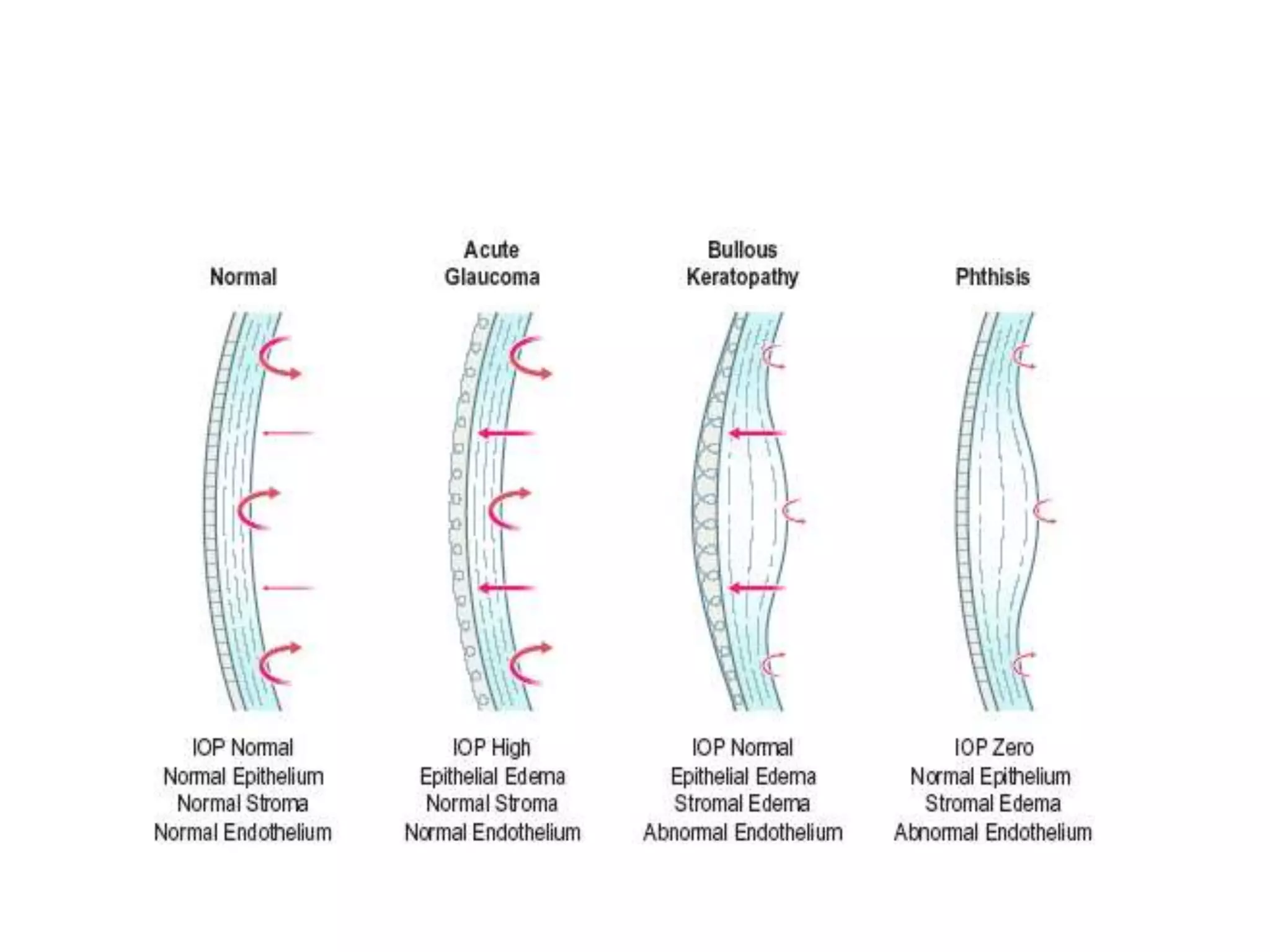 Corneal edema numbers