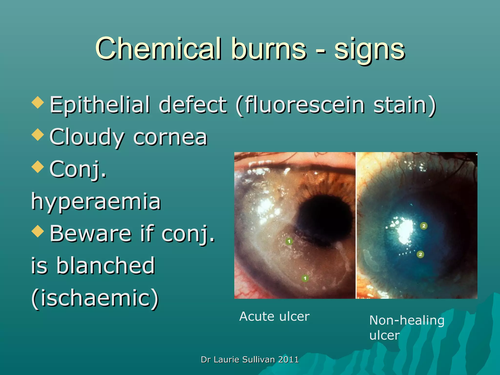 Corneal emergencies | PPT