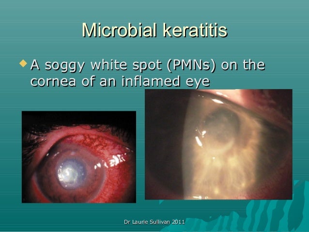 Corneal Emergencies 16 Microbial Keratitismicrobial Keratitis A Soggy White Spot