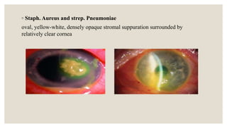◦ Staph. Aureus and strep. Pneumoniae
oval, yellow-white, densely opaque stromal suppuration surrounded by
relatively clear cornea
 