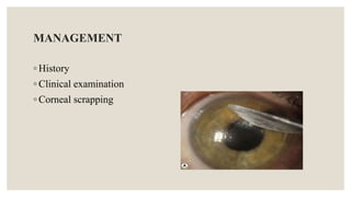 MANAGEMENT
◦ History
◦ Clinical examination
◦ Corneal scrapping
 