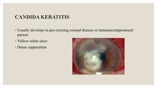 CANDIDA KERATITIS
◦ Usually develops in pre-exixting corneal disease or immunocompromised
patient
◦ Yellow-white ulcer
◦ Dense suppuration
 