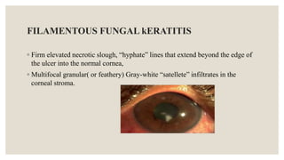 FILAMENTOUS FUNGAL kERATITIS
◦ Firm elevated necrotic slough, “hyphate” lines that extend beyond the edge of
the ulcer into the normal cornea,
◦ Multifocal granular( or feathery) Gray-white “satellete” infiltrates in the
corneal stroma.
 