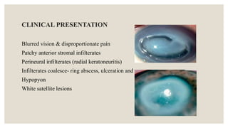 CLINICAL PRESENTATION
Blurred vision & disproportionate pain
Patchy anterior stromal infilterates
Perineural infilterates (radial keratoneuritis)
Infilterates coalesce- ring abscess, ulceration and
Hypopyon
White satellite lesions
 