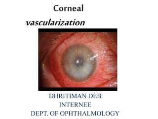 Corneal
vascularization
DHRITIMAN DEB
INTERNEE
DEPT. OF OPHTHALMOLOGY
 