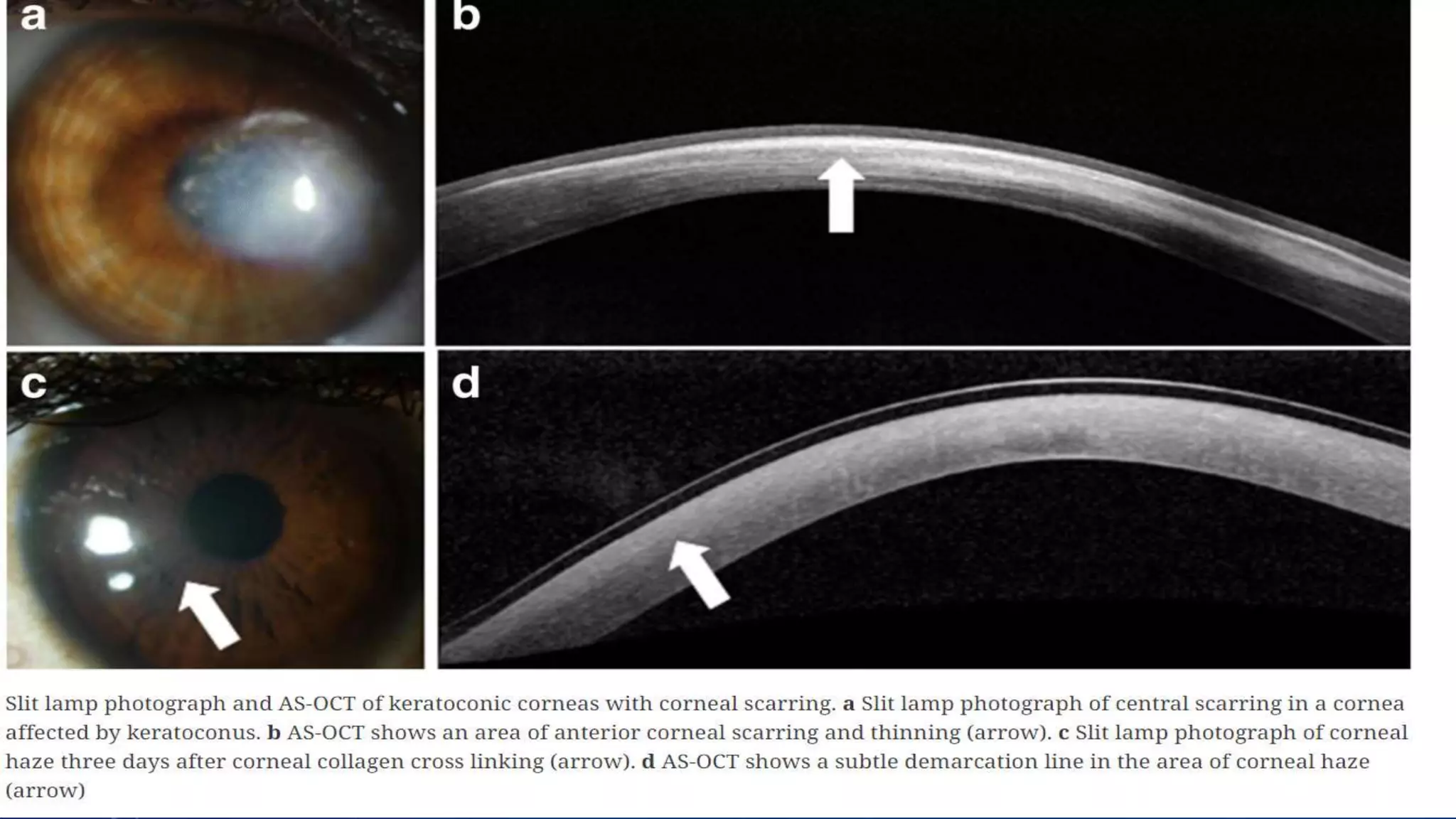 Anterior segment and Corneal OCT review | PPSX