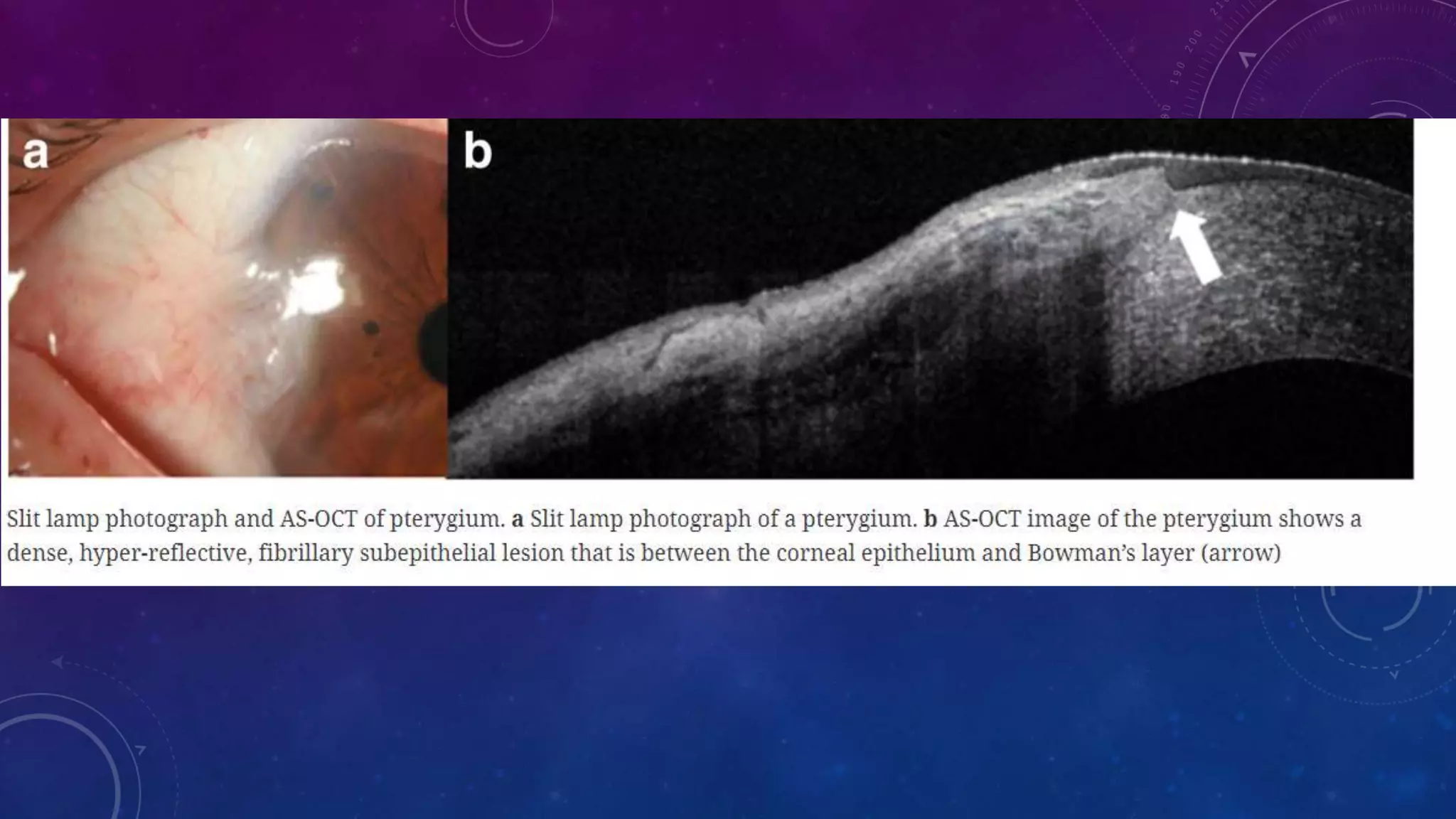 Anterior segment and Corneal OCT review | PPSX