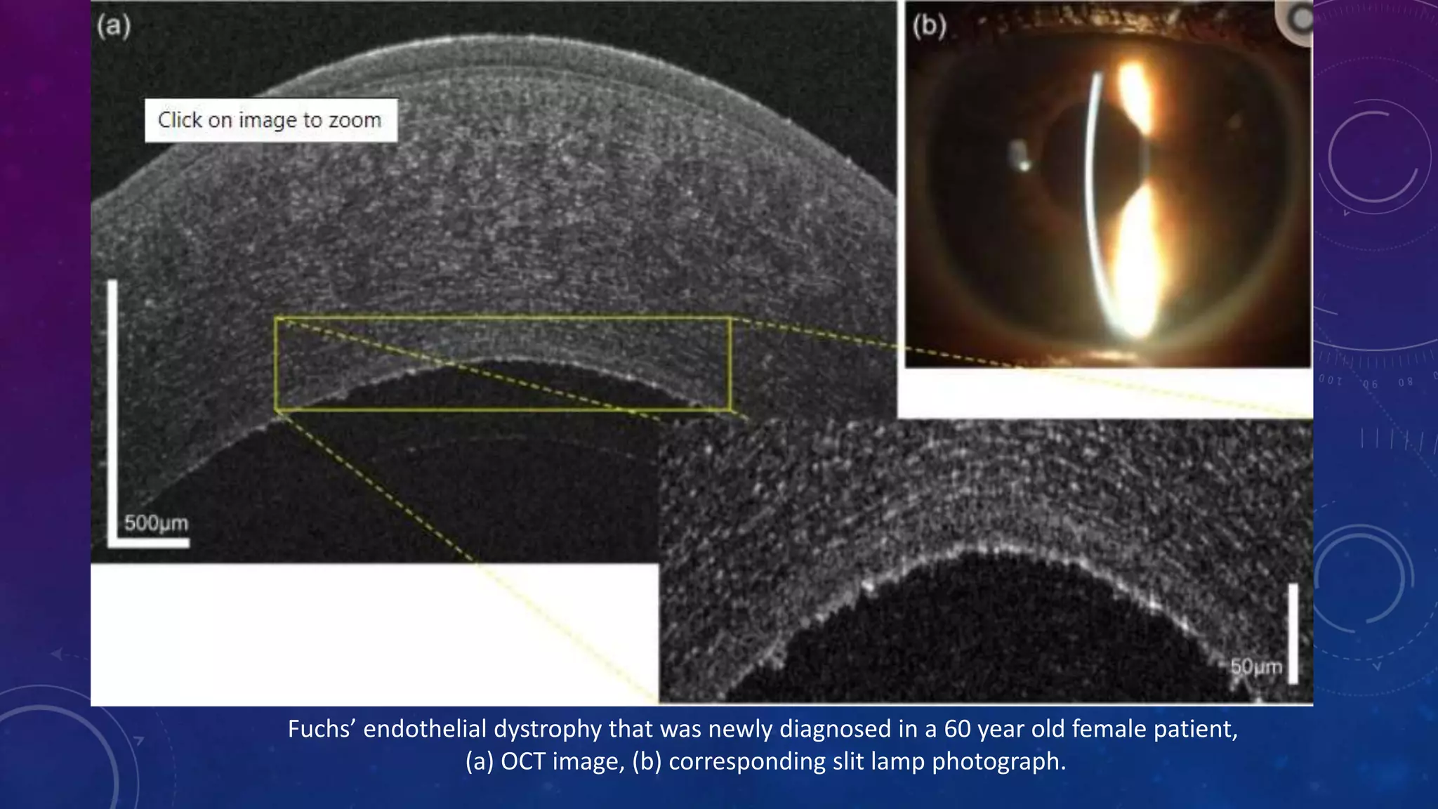 Anterior segment and Corneal OCT review | PPSX