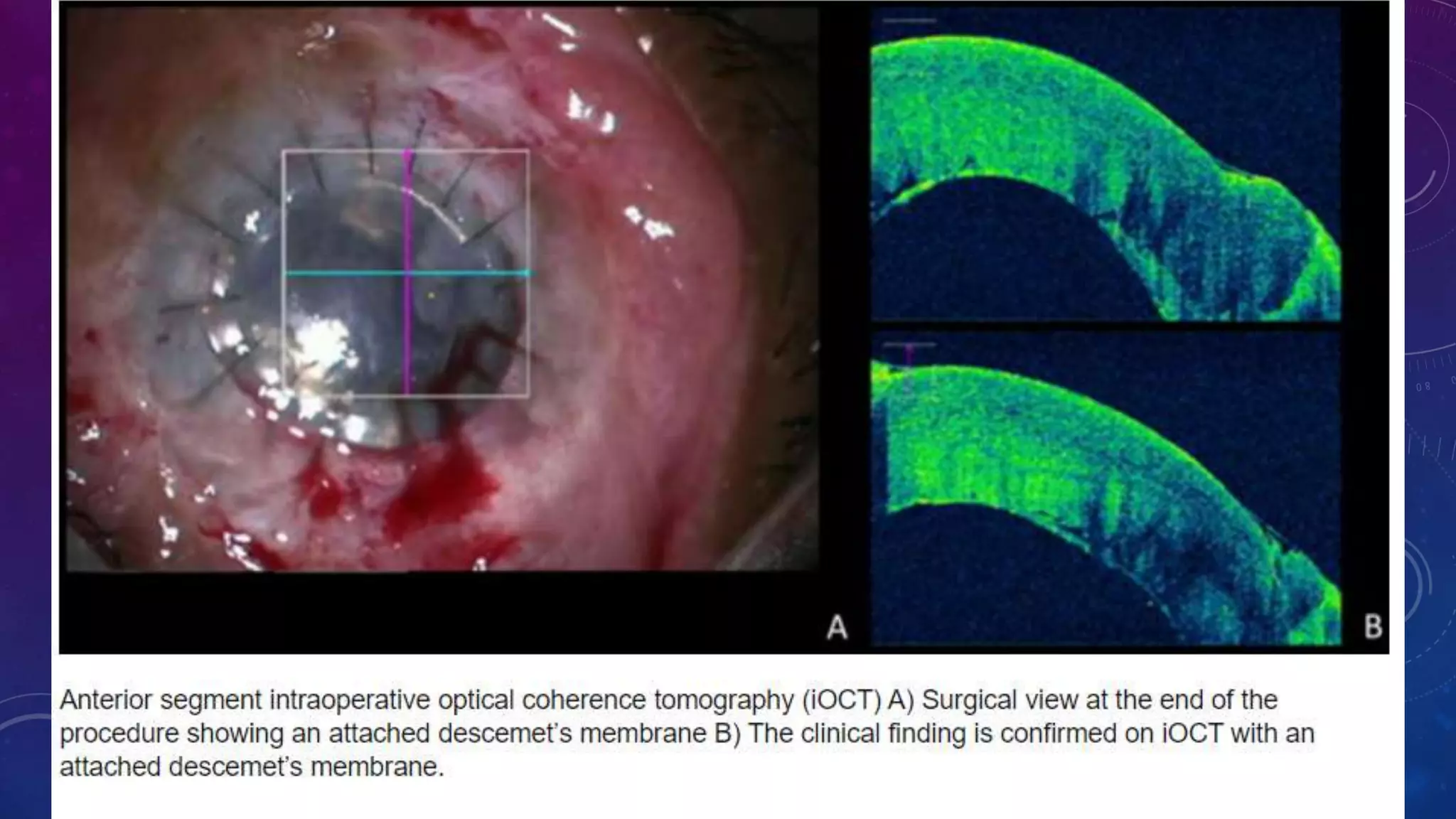 Anterior segment and Corneal OCT review | PPSX