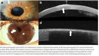 Anterior segment and Corneal OCT review | PPSX