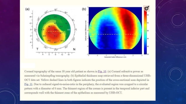 Anterior segment and Corneal OCT review | PPSX