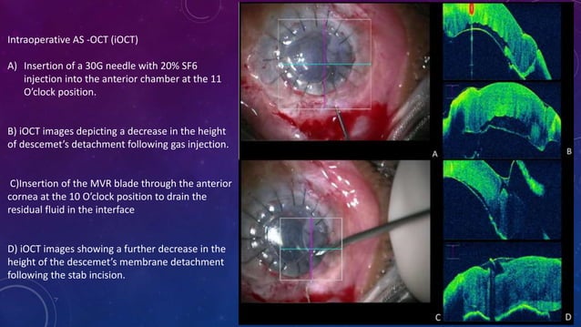 Anterior segment and Corneal OCT review | PPSX