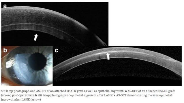 Anterior segment and Corneal OCT review | PPSX