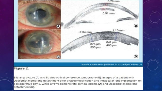 Anterior segment and Corneal OCT review | PPSX