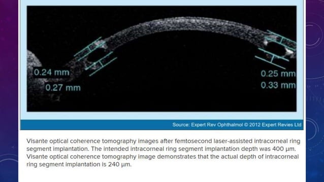 Anterior segment and Corneal OCT review | PPSX