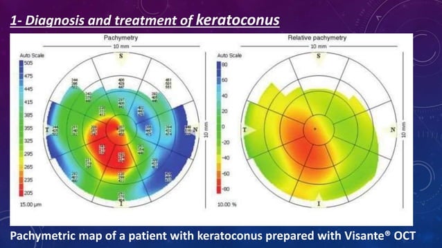 Anterior segment and Corneal OCT review | PPSX