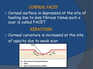 CORNEAL FACET
 Corneal surface is depressed at the site of
healing due to less fibrous tissue,such a
scar is called FACET
KERACTASIA
 Corneal curvature is increased at the site
of opacity due to weak scar
 