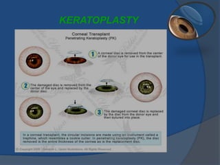 KERATOPLASTY
 