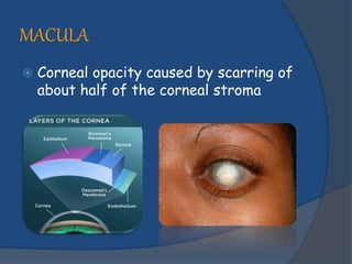 MACULA
 Corneal opacity caused by scarring of
about half of the corneal stroma
 