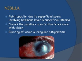 Corneal opacity